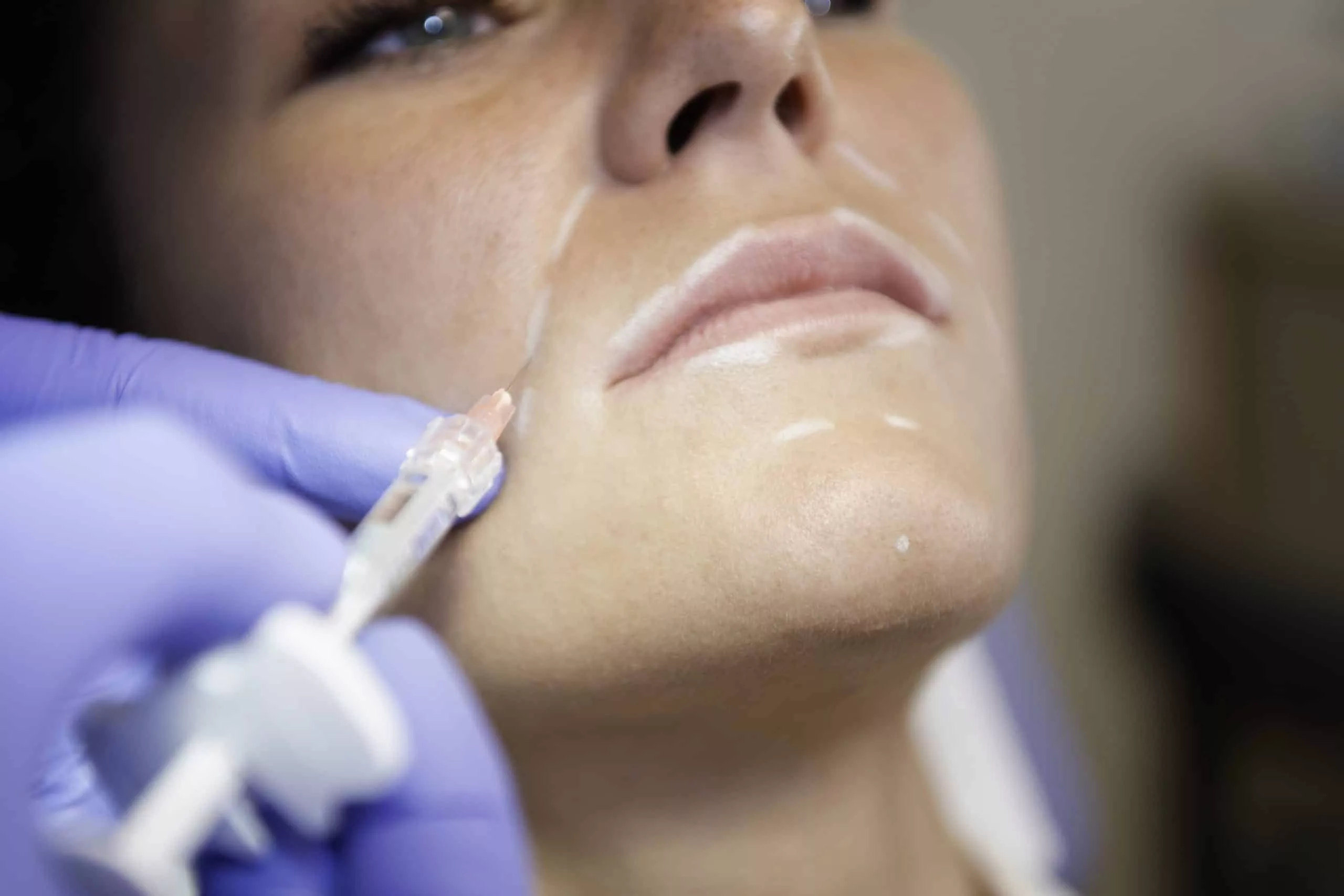 clinica-belmedic-medicina-estetica-porto-acido-hialuronico