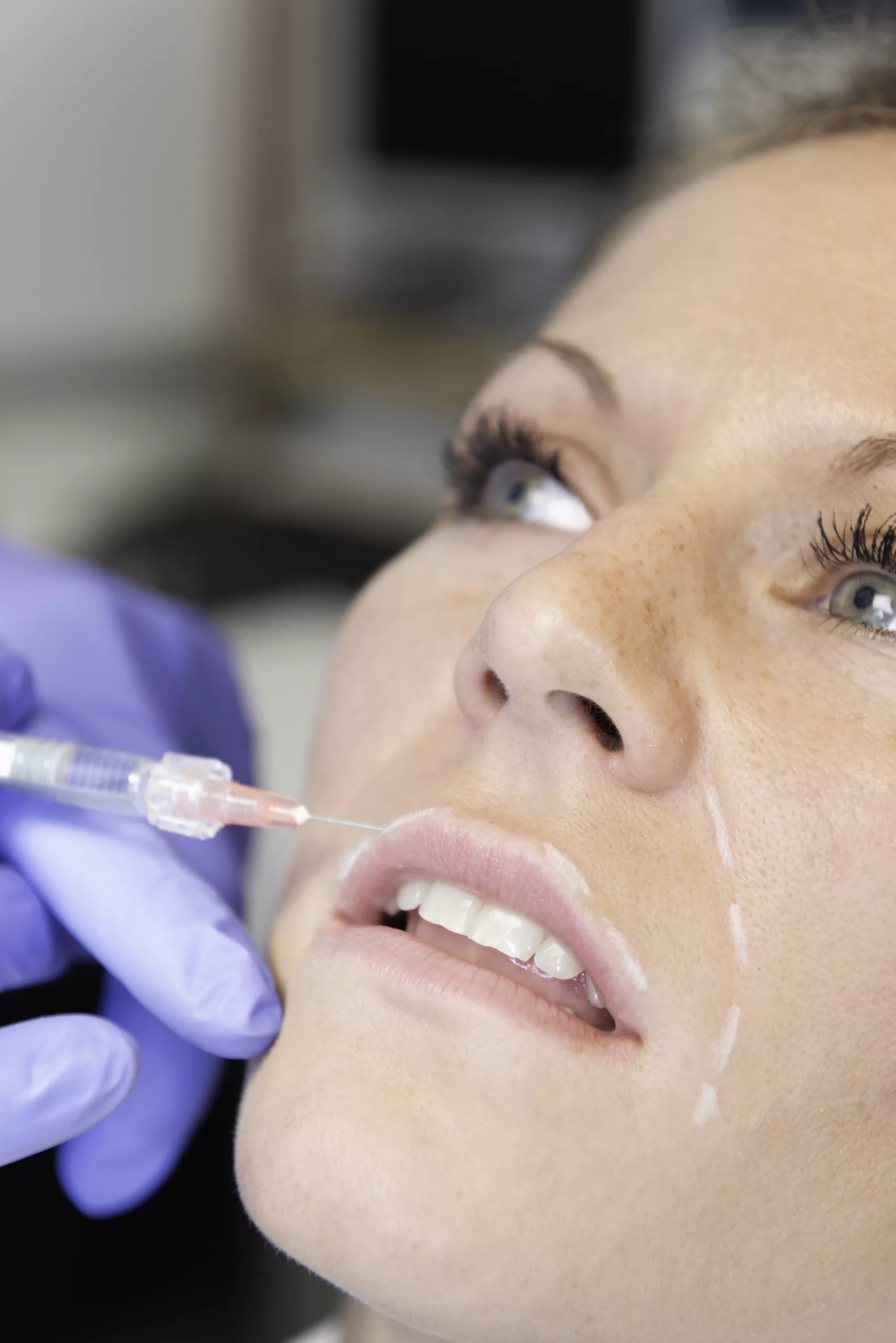 clinica-belmedic-medicina-estetica-porto-tratamento-acido-hialuronico
