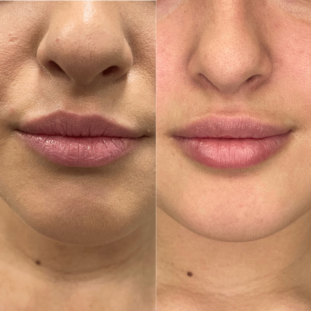clinica-belmedic-porto-antes-e-depois-correcao-assimetria-labial-2
