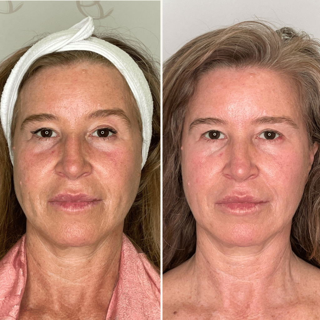 clinica-belmedic-porto-antes-e-depois-marcas-full-face