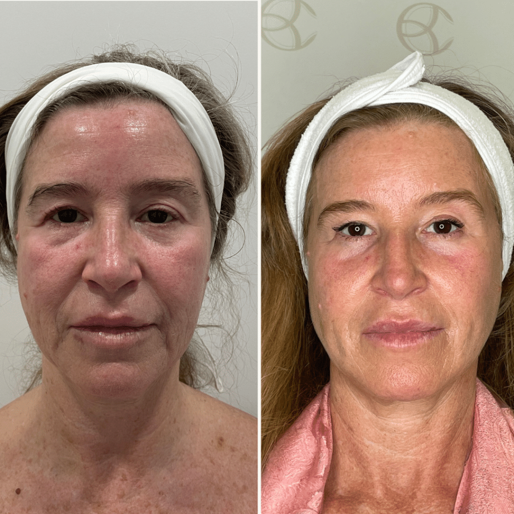 clinica-belmedic-porto-antes-e-depois-full-face-2