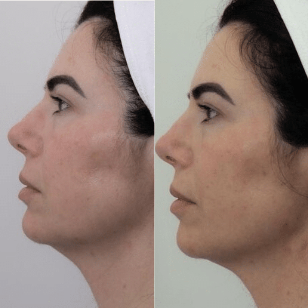 clinica-belmedic-porto-antes-e-depois-mandibula-e-toxina
