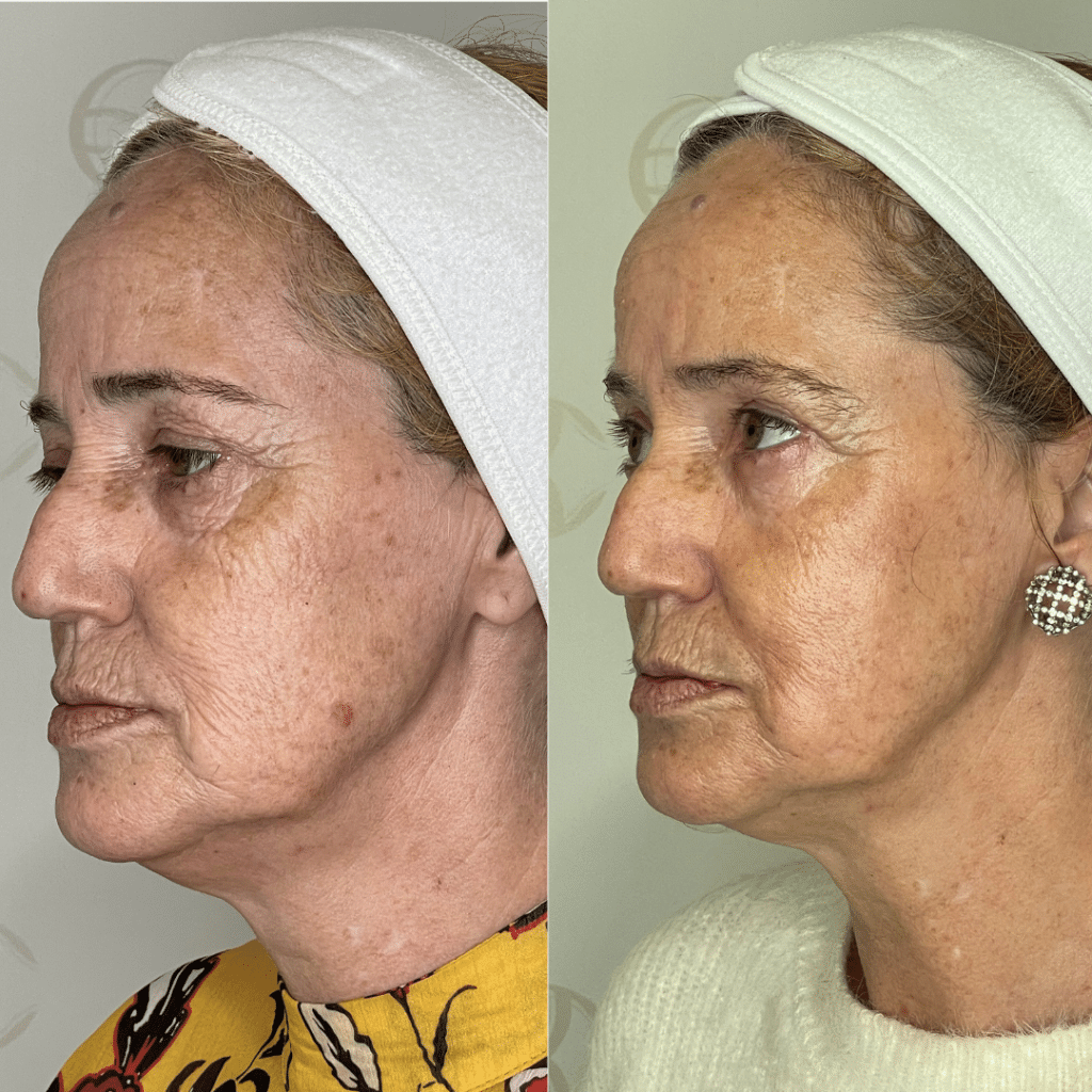 clinica-belmedic-porto-antes-e-depois-marcas-miceoagulhamento-rugas