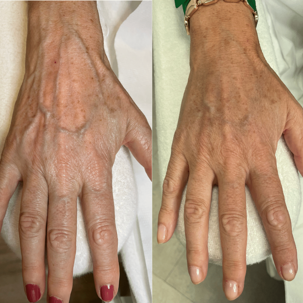 clinica-belmedic-porto-antes-e-depois-maos