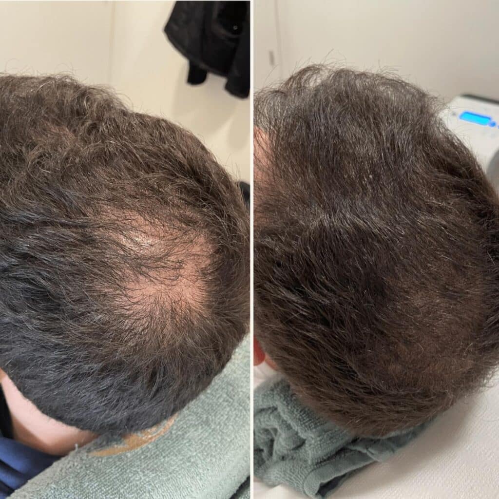 Antes e depois PRP Capilar