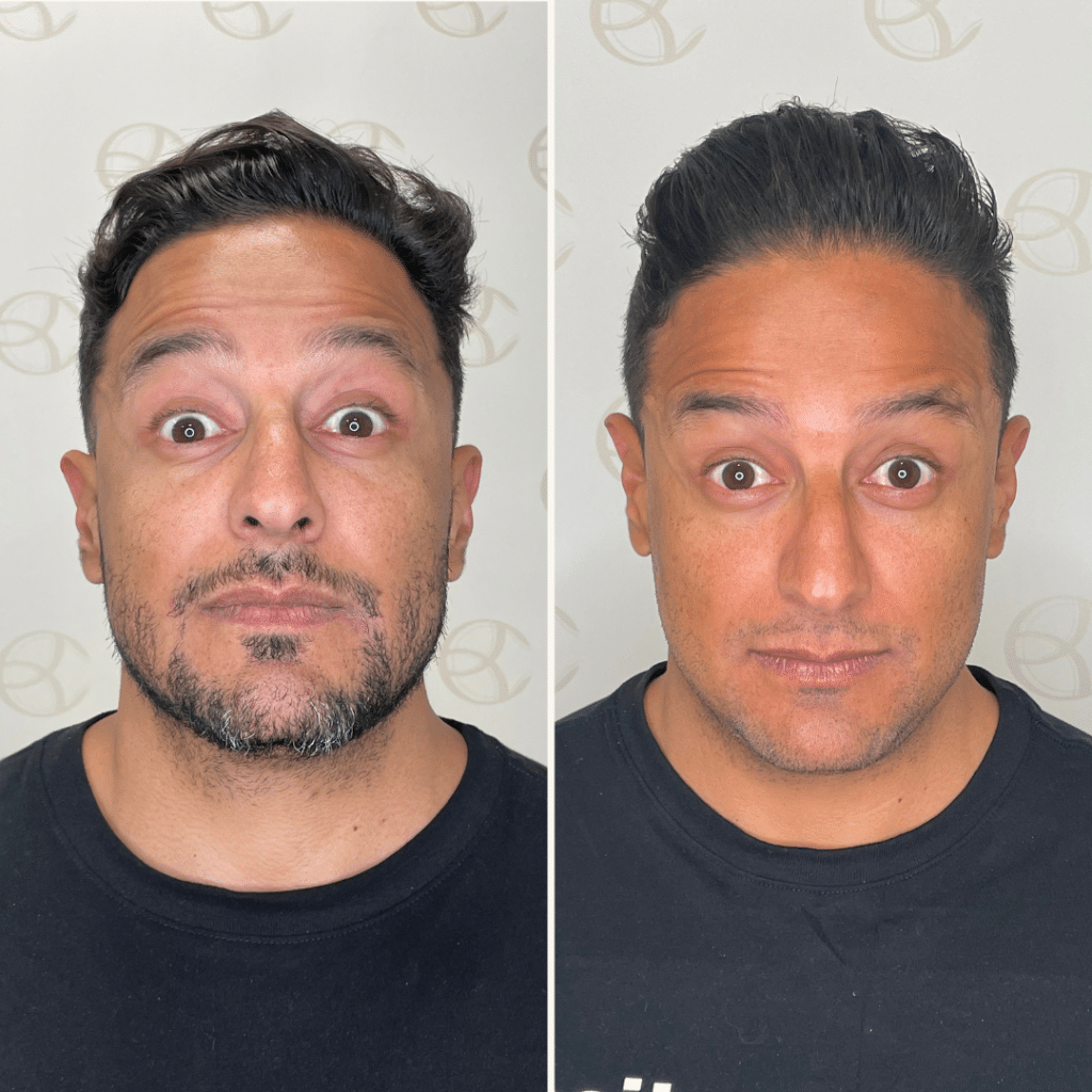 clinica-belmedic-porto-antes-e-depois-toxina-botulinica