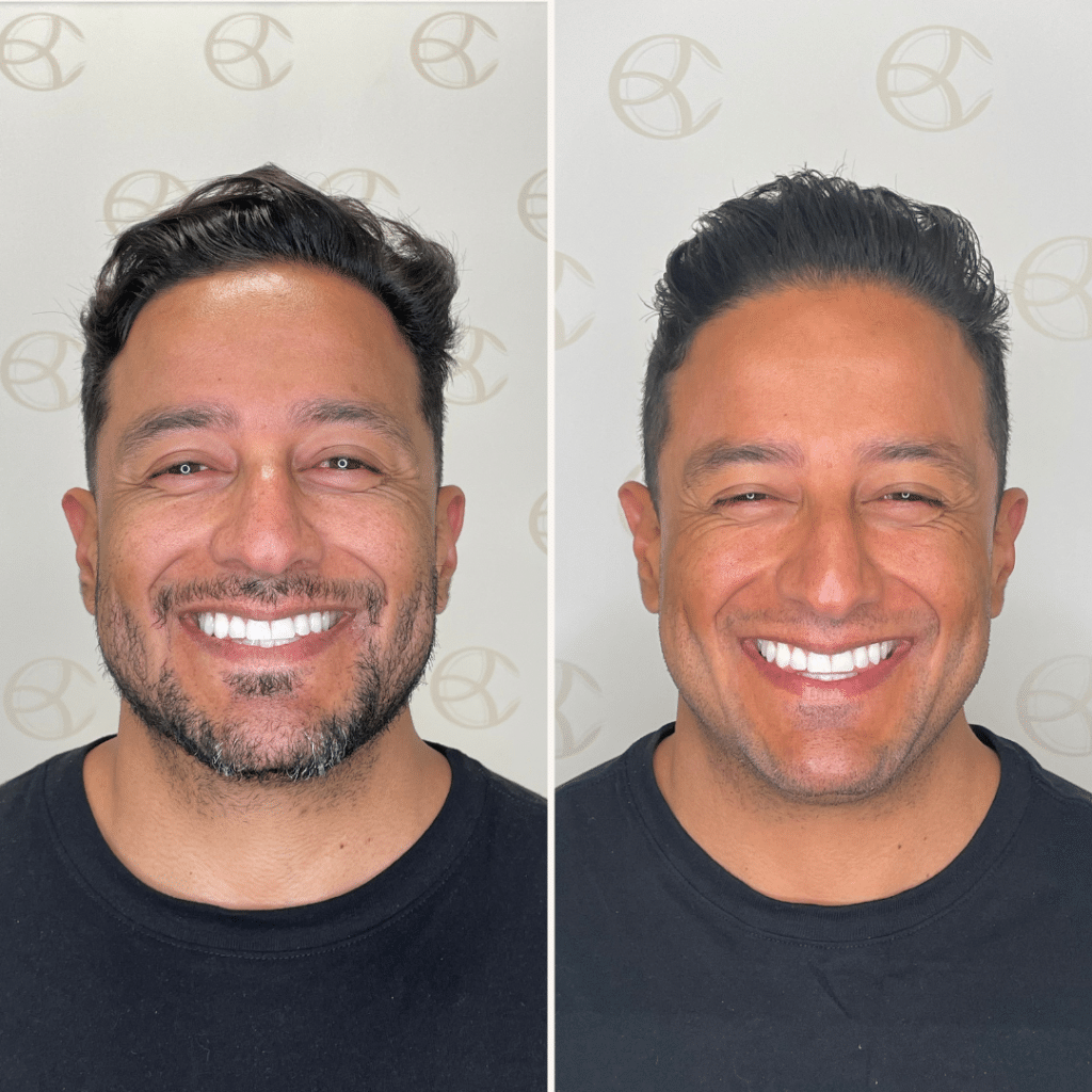 clinica-belmedic-porto-antes-e-depois-toxina-botulinica-2