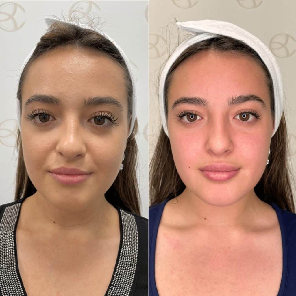 Antes e depois assimetria labial