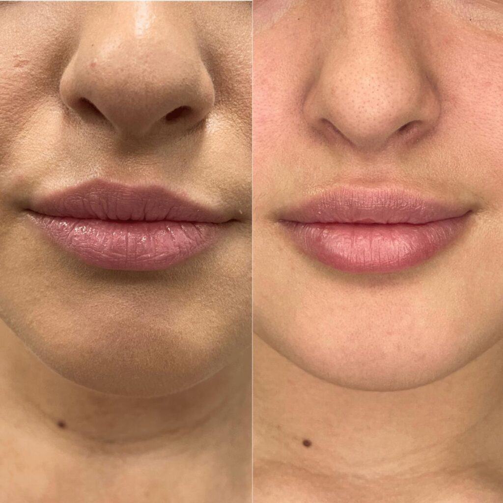 Antes e depois assimetria labial
