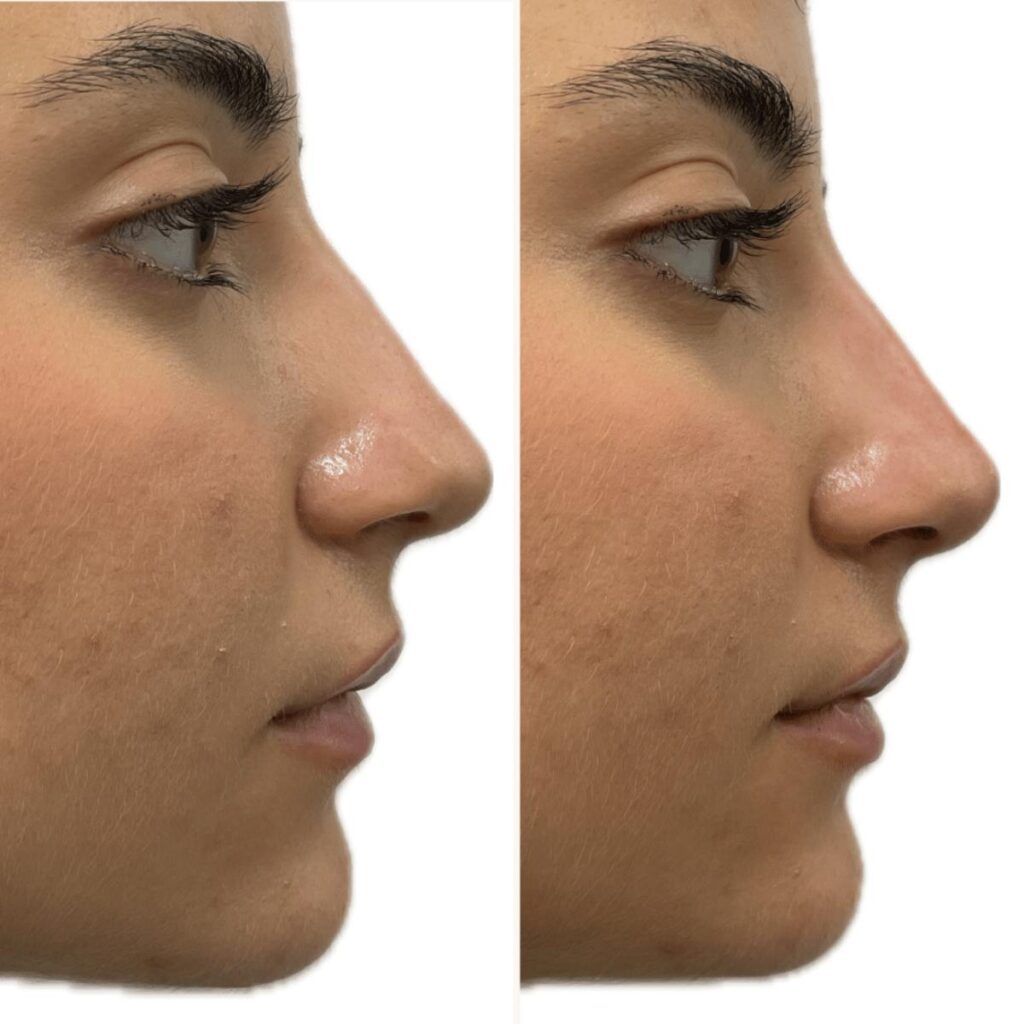 Antes e depois correção nariz com ácido hialurónico