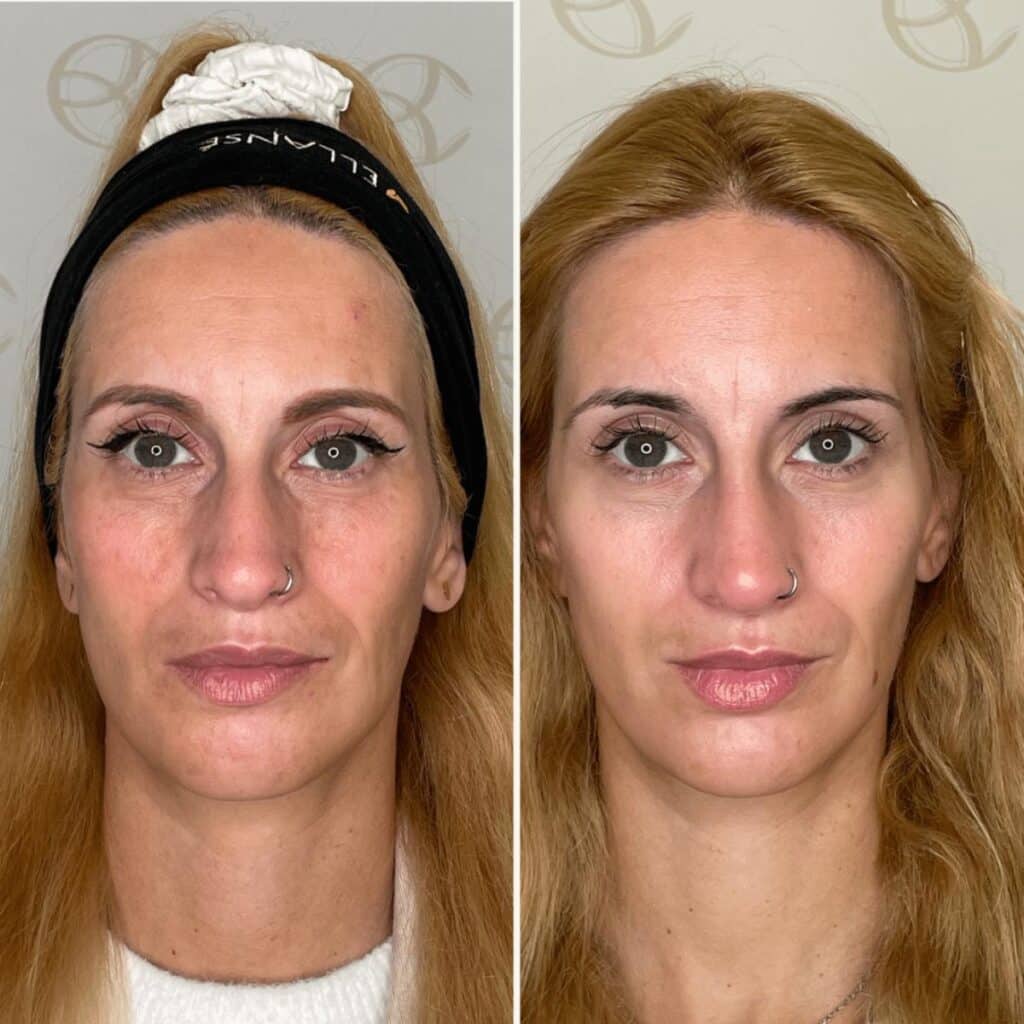 Antes e depois correção nariz com ácido hialurónico