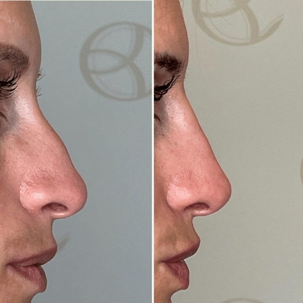 Antes e depois correção nariz com ácido hialurónico