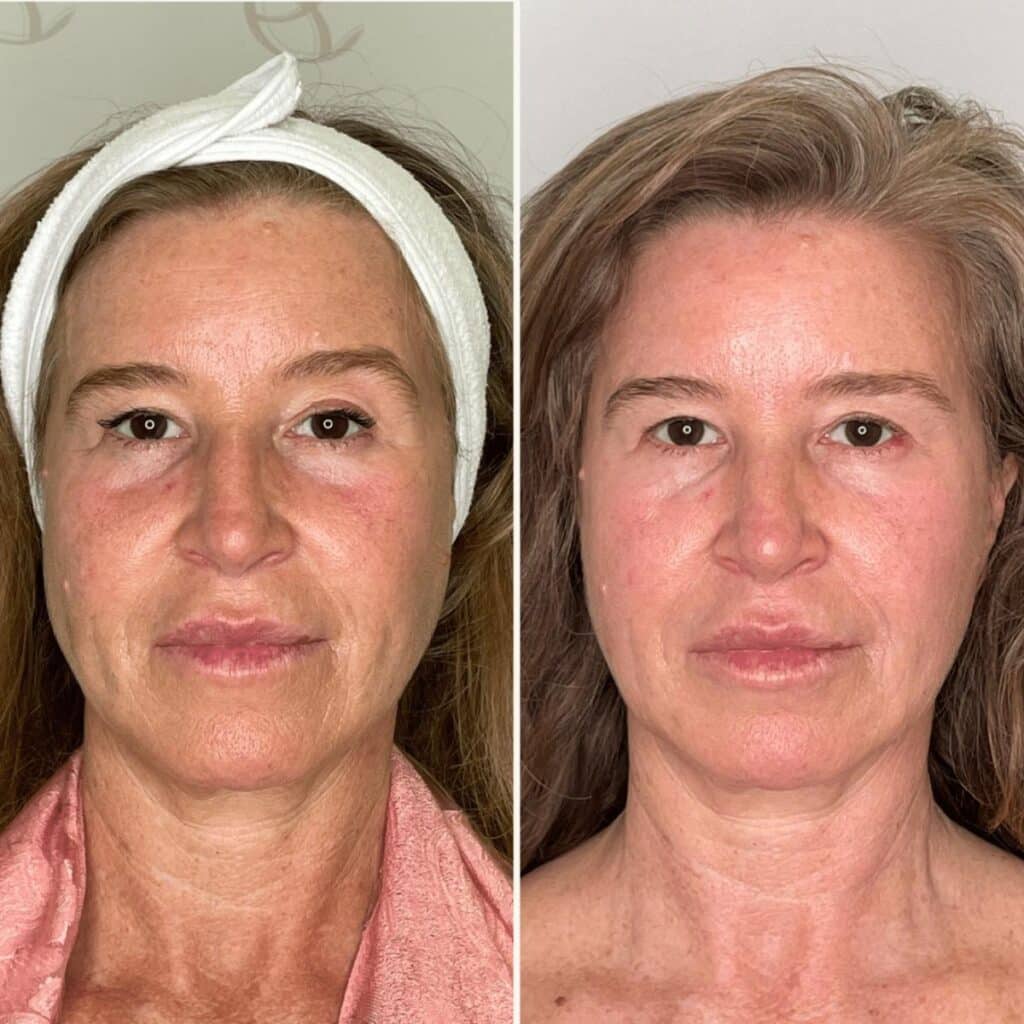 Antes e depois full face