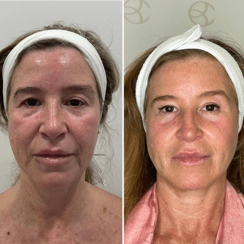 Antes e depos full face