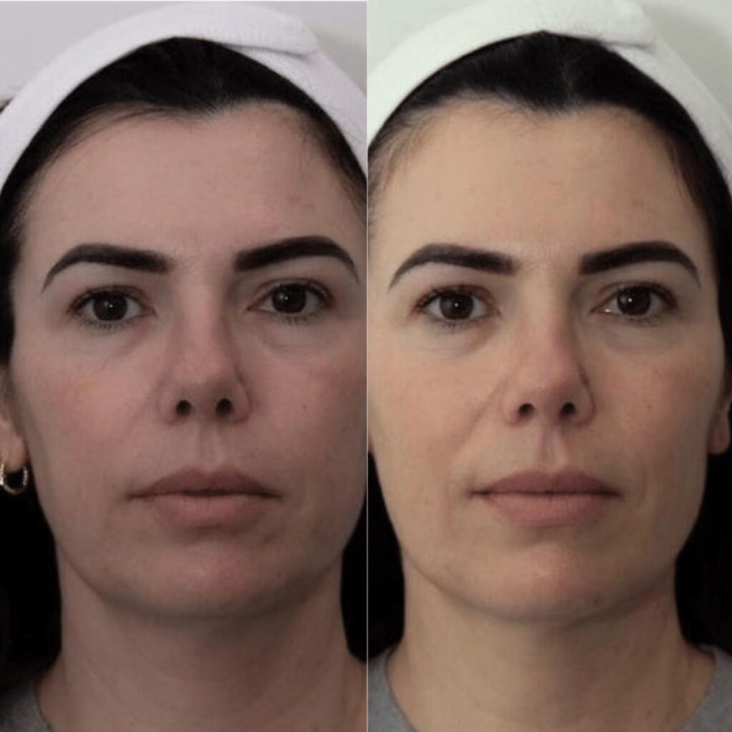 Antes e depois mandíbula e toxina