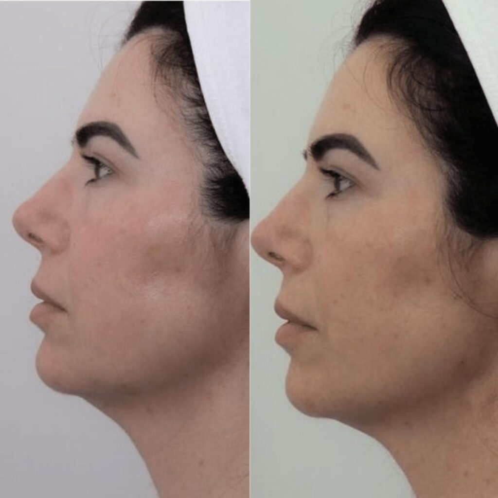 Antes e depois mandíbula e toxina