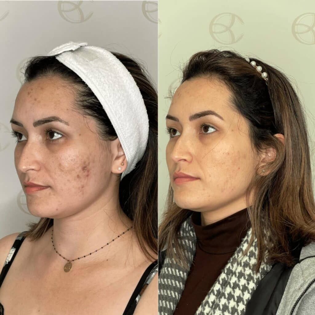 Antes e depois marcas de acne e pigmentação