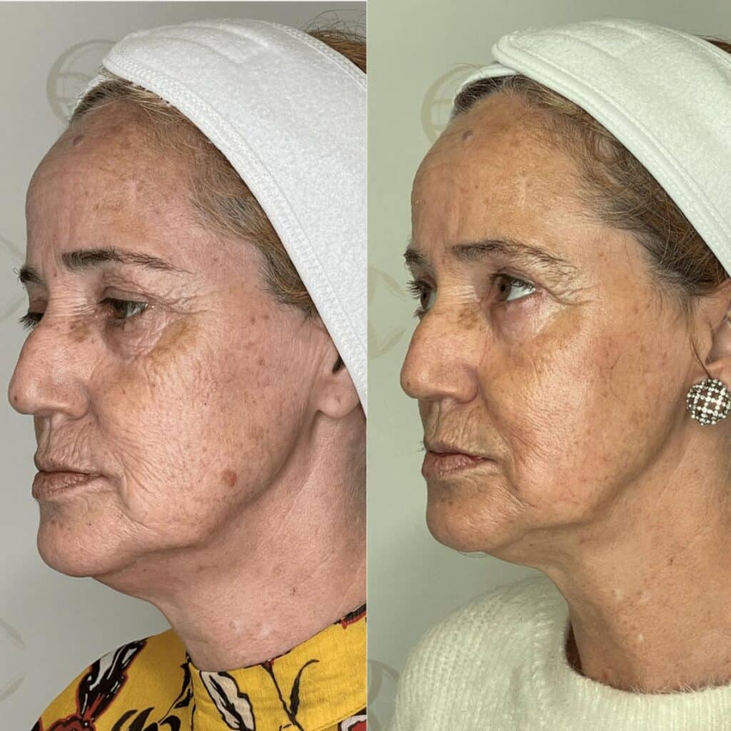 Antes e depois microagulhamento rugas