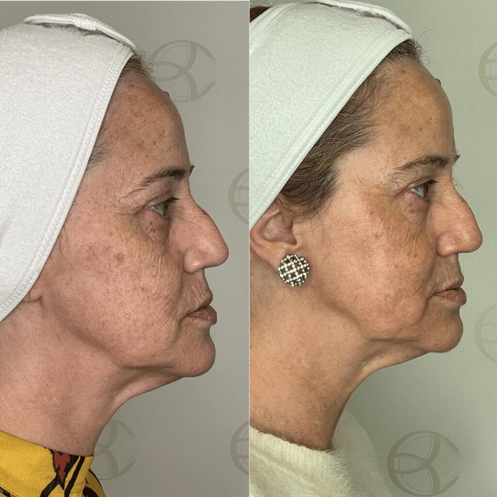 Antes e depois microagulhamento rugas