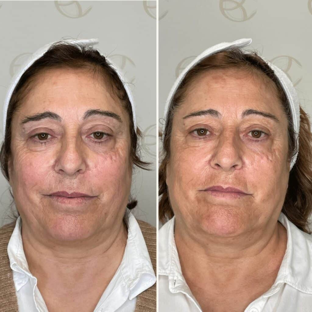 Antes e depois manchas no rosto