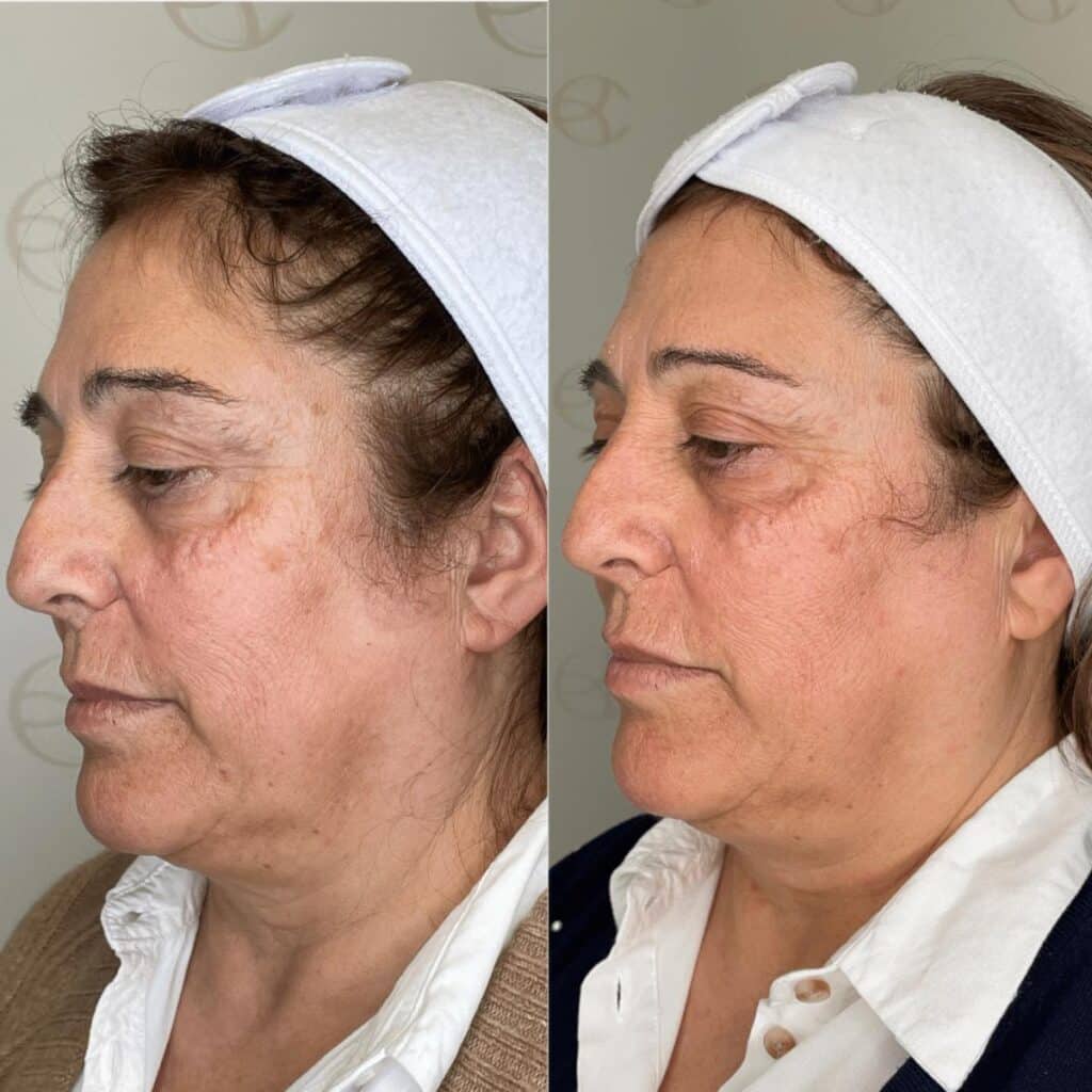 Antes e depois manchas no rosto