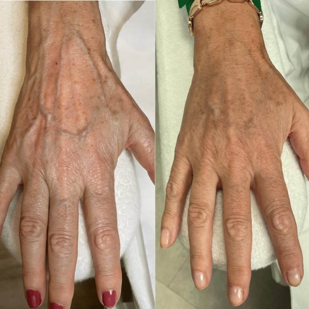 Antes e depois mãos