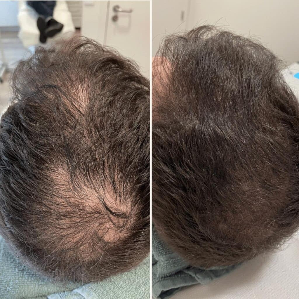 Antes e depois PRP Capilar