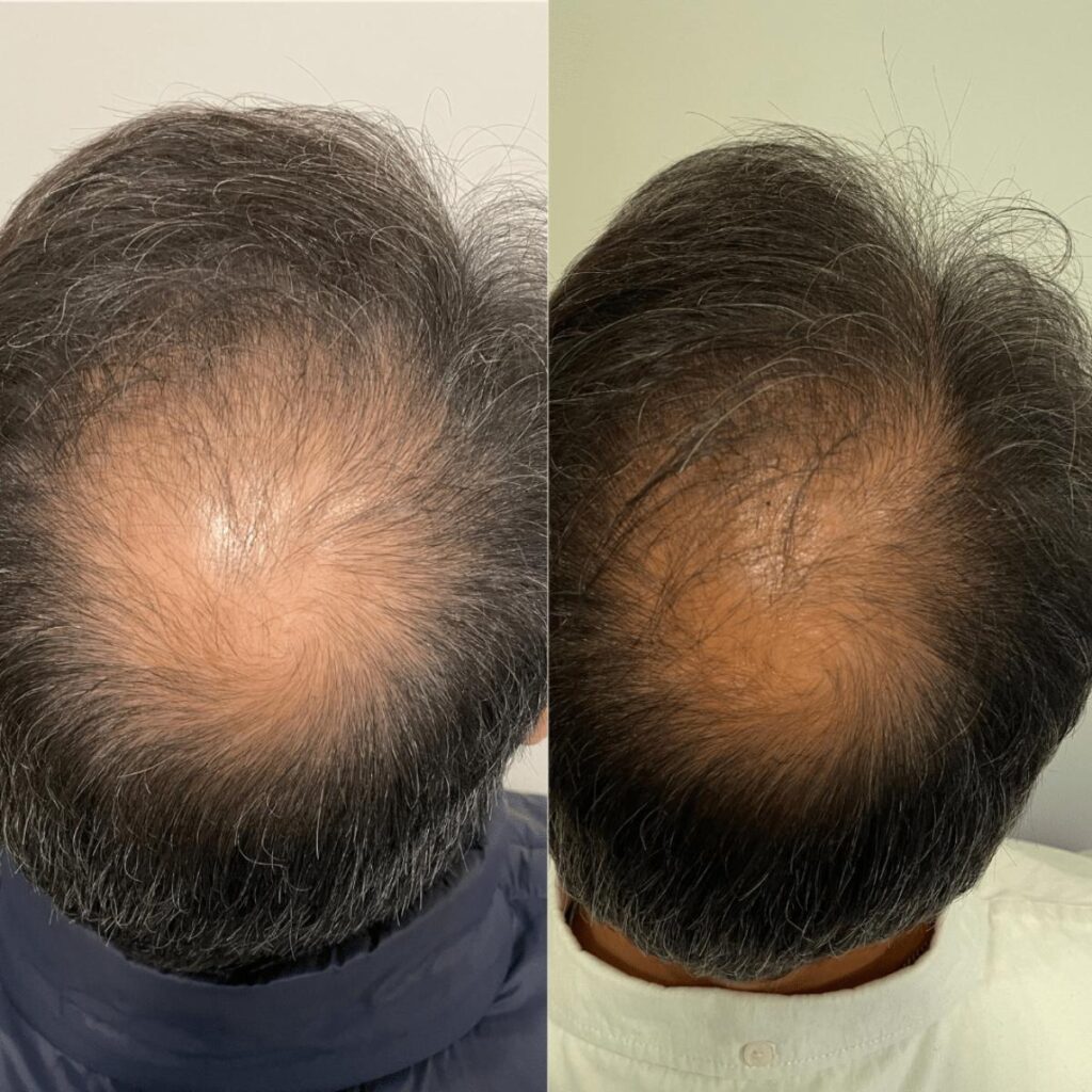 Antes e depois PRP Capilar