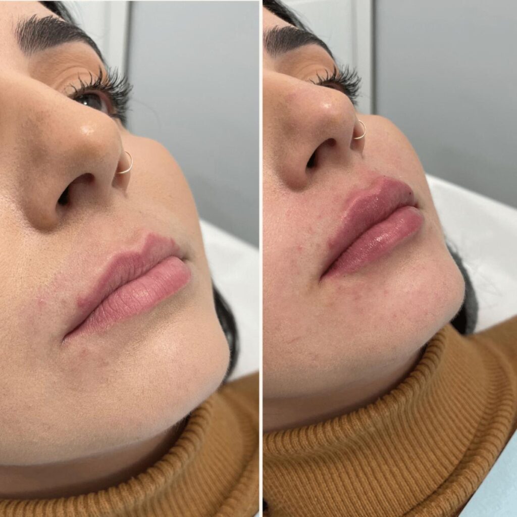 Antes e depois preenchimento labial