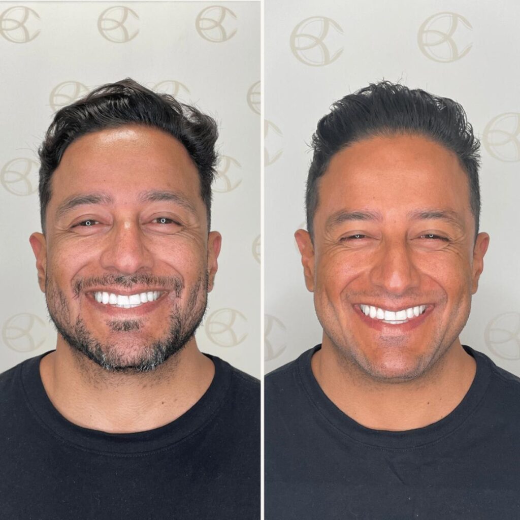 Antes e depois toxina botulínica